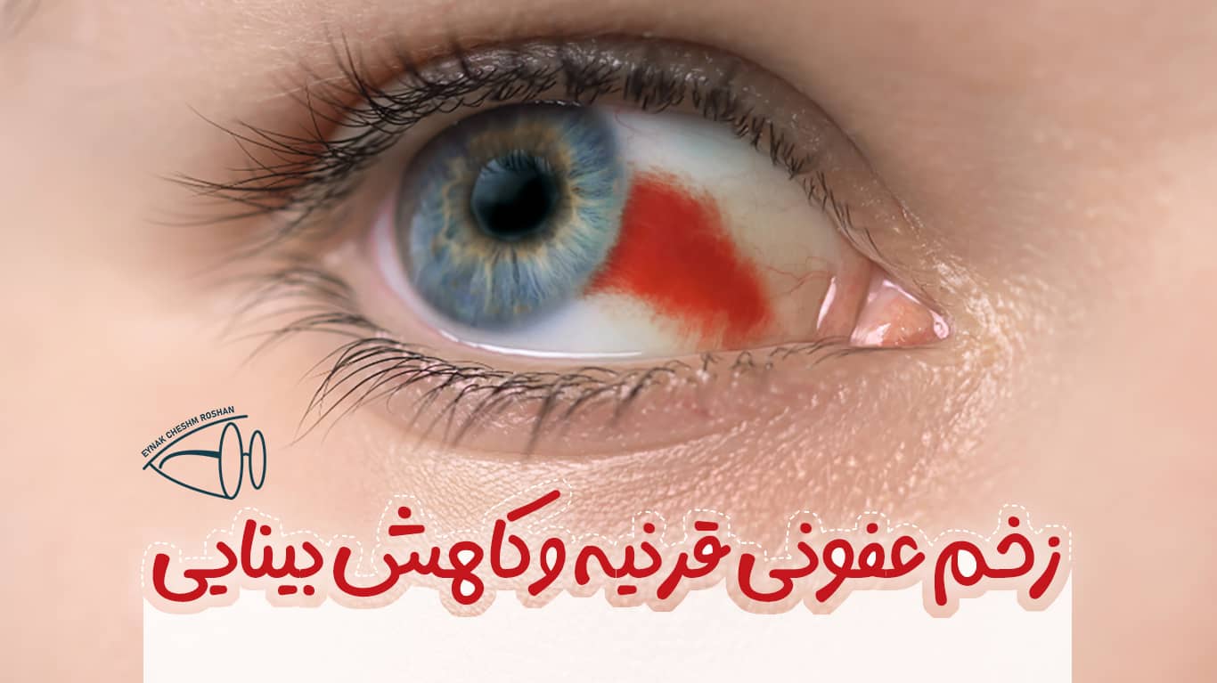 رابطه زخم عفونی قرنیه و کاهش بینایی در مناطق گرم و مرطوب